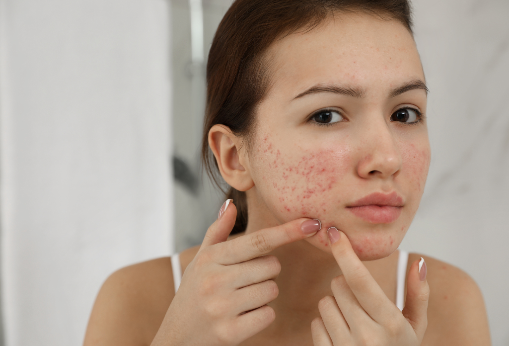 Hyperpigmentation Acne: Causes and Treatment